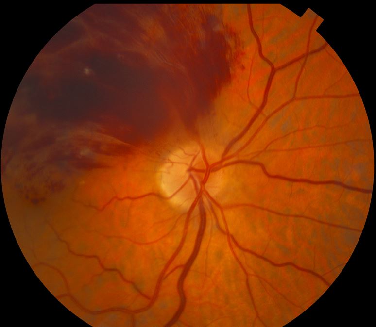 Branch Retinal Vein Occlusion in a Patient With Familial Hyperlipidemia